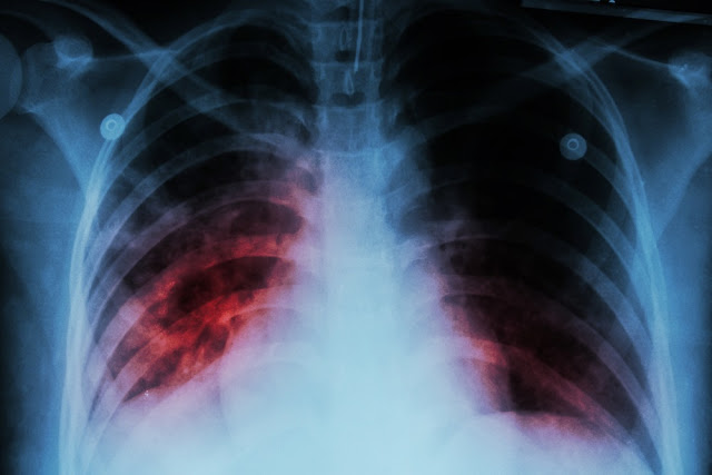 Εκατομμύρια νέα κρούσματα φυματίωσης λόγω κοροναϊού - Φωτογραφία 1