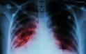 Εκατομμύρια νέα κρούσματα φυματίωσης λόγω κοροναϊού
