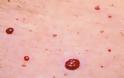 Kόκκινες ελιές στο δέρμα (κερασοειδή αιμαγγειώματα). Είναι επικίνδυνες; Πώς αντιμετωπίζονται; - Φωτογραφία 1