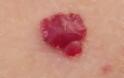 Kόκκινες ελιές στο δέρμα (κερασοειδή αιμαγγειώματα). Είναι επικίνδυνες; Πώς αντιμετωπίζονται; - Φωτογραφία 2
