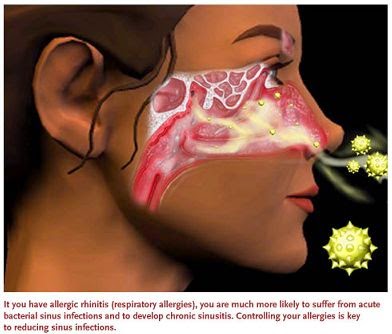 Αλλεργία. Τι είναι και πώς μπορεί να αντιμετωπιστούν οι αλλεργίες; Υπάρχει τρόπος πρόληψης; - Φωτογραφία 3