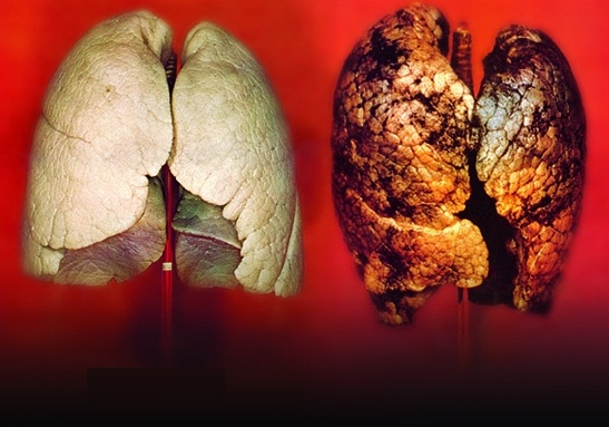 Οι καρκινογόνες ουσίες του τσιγάρου. Ποιες σοβαρές ασθένειες προκαλεί το κάπνισμα εκτός από καρκίνο; - Φωτογραφία 4