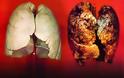 Οι καρκινογόνες ουσίες του τσιγάρου. Ποιες σοβαρές ασθένειες προκαλεί το κάπνισμα εκτός από καρκίνο; - Φωτογραφία 4