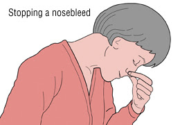Γιατί ματώνει η μύτη; Ρινορραγία, επίσταξη. Τι πρέπει να κάνουμε; (video) - Φωτογραφία 4