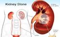 Πώς δημιουργούνται οι πέτρες στα νεφρά - νεφρολιθίαση; Ποιες τροφές, βότανα κάνουν καλό; - Φωτογραφία 5