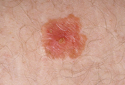 Προσοχή μοιάζει με σπυράκι, η Νόσος του Bowen, ενδοεπιδερμιδικός ακανθοκυτταρικός καρκίνος του δέρματος - Φωτογραφία 1