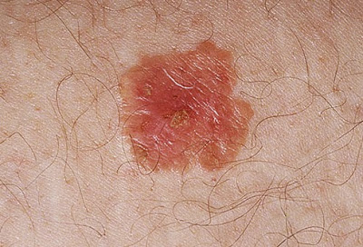 Προσοχή μοιάζει με σπυράκι, η Νόσος του Bowen, ενδοεπιδερμιδικός ακανθοκυτταρικός καρκίνος του δέρματος - Φωτογραφία 4