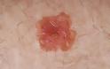 Προσοχή μοιάζει με σπυράκι, η Νόσος του Bowen, ενδοεπιδερμιδικός ακανθοκυτταρικός καρκίνος του δέρματος - Φωτογραφία 4