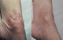 Προσοχή μοιάζει με σπυράκι, η Νόσος του Bowen, ενδοεπιδερμιδικός ακανθοκυτταρικός καρκίνος του δέρματος - Φωτογραφία 5