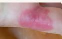 Προσοχή μοιάζει με σπυράκι, η Νόσος του Bowen, ενδοεπιδερμιδικός ακανθοκυτταρικός καρκίνος του δέρματος - Φωτογραφία 6