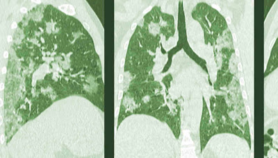 Καρκίνος του πνεύμονα: Πως τον επηρεάζει η νικοτίνη - Φωτογραφία 1