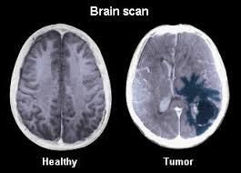 Καρκίνος στον εγκέφαλο, όγκος με ζαλάδες, πονοκέφαλο, ναυτία, αστάθεια, σπασμοί - Φωτογραφία 6