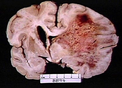 Καρκίνος στον εγκέφαλο, όγκος με ζαλάδες, πονοκέφαλο, ναυτία, αστάθεια, σπασμοί - Φωτογραφία 7