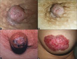 Νόσος Paget καρκίνος μαστού που μιμείται την μαστίτιδα - Φωτογραφία 2