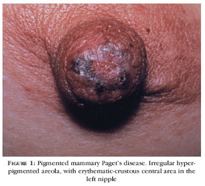 Νόσος Paget καρκίνος μαστού που μιμείται την μαστίτιδα - Φωτογραφία 4