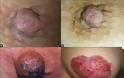 Νόσος Paget καρκίνος μαστού που μιμείται την μαστίτιδα - Φωτογραφία 2