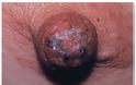 Νόσος Paget καρκίνος μαστού που μιμείται την μαστίτιδα - Φωτογραφία 4