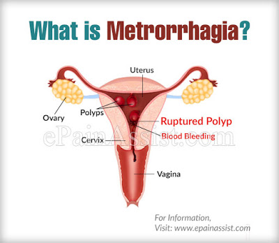 Γυναικολογική αιμορραγία, μητρορραγία, κολπική αιμόρροια εκτός περιόδου, στην εγκυμοσύνη ή μετά την εμμηνόπαυση - Φωτογραφία 4