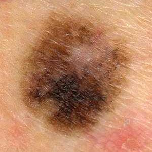 Κακοήθεις όγκοι του δέρματος. Χαρακτηριστικά που έχουν οι ελιές που προειδοποιούν για πιθανό καρκίνο - Φωτογραφία 1