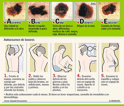 Κακοήθεις όγκοι του δέρματος. Χαρακτηριστικά που έχουν οι ελιές που προειδοποιούν για πιθανό καρκίνο - Φωτογραφία 2