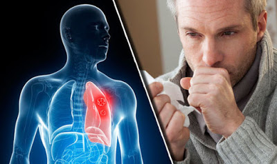 Ο επίμονος βήχας μπορεί να οφείλεται σε καρκίνο του πνεύμονα; - Φωτογραφία 1