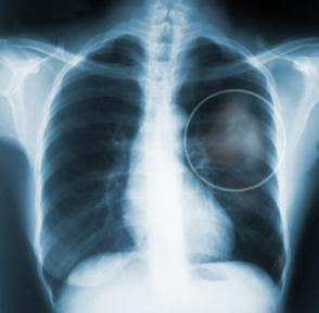 Ο επίμονος βήχας μπορεί να οφείλεται σε καρκίνο του πνεύμονα; - Φωτογραφία 2