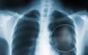 Ο επίμονος βήχας μπορεί να οφείλεται σε καρκίνο του πνεύμονα; - Φωτογραφία 2