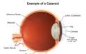 Καταρράκτης η συχνότερη αιτία μείωσης της όρασης, σε όλο τον κόσμο - Φωτογραφία 2