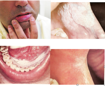Λευκοπλακία Προκαρκινική βλάβη στο στόμα που πρέπει να αφαιρείται - Φωτογραφία 2