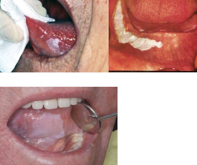 Λευκοπλακία Προκαρκινική βλάβη στο στόμα που πρέπει να αφαιρείται - Φωτογραφία 3