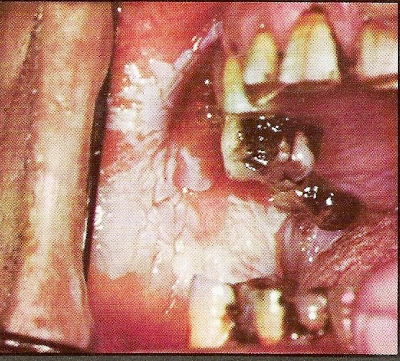 Λευκοπλακία Προκαρκινική βλάβη στο στόμα που πρέπει να αφαιρείται - Φωτογραφία 5