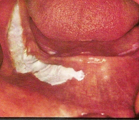 Λευκοπλακία Προκαρκινική βλάβη στο στόμα που πρέπει να αφαιρείται - Φωτογραφία 7