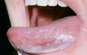 Λευκοπλακία Προκαρκινική βλάβη στο στόμα που πρέπει να αφαιρείται - Φωτογραφία 1