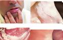 Λευκοπλακία Προκαρκινική βλάβη στο στόμα που πρέπει να αφαιρείται - Φωτογραφία 2