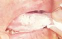 Λευκοπλακία Προκαρκινική βλάβη στο στόμα που πρέπει να αφαιρείται - Φωτογραφία 6