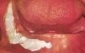 Λευκοπλακία Προκαρκινική βλάβη στο στόμα που πρέπει να αφαιρείται - Φωτογραφία 7