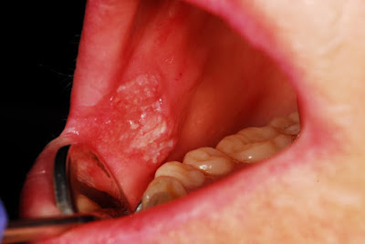 Καρκίνος στόματος. Που οφείλεται, ποια τα συμπτώματα και πώς γίνεται η αυτοεξέταση (video) - Φωτογραφία 2