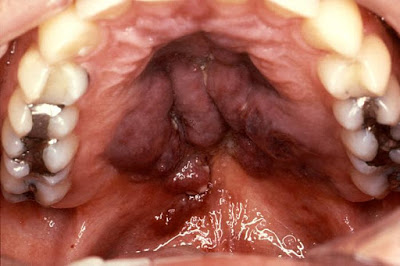 Καρκίνος στόματος. Που οφείλεται, ποια τα συμπτώματα και πώς γίνεται η αυτοεξέταση (video) - Φωτογραφία 3