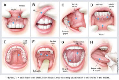 Καρκίνος στόματος. Που οφείλεται, ποια τα συμπτώματα και πώς γίνεται η αυτοεξέταση (video) - Φωτογραφία 6