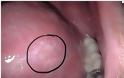 Καρκίνος στόματος. Που οφείλεται, ποια τα συμπτώματα και πώς γίνεται η αυτοεξέταση (video) - Φωτογραφία 1