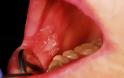 Καρκίνος στόματος. Που οφείλεται, ποια τα συμπτώματα και πώς γίνεται η αυτοεξέταση (video) - Φωτογραφία 2