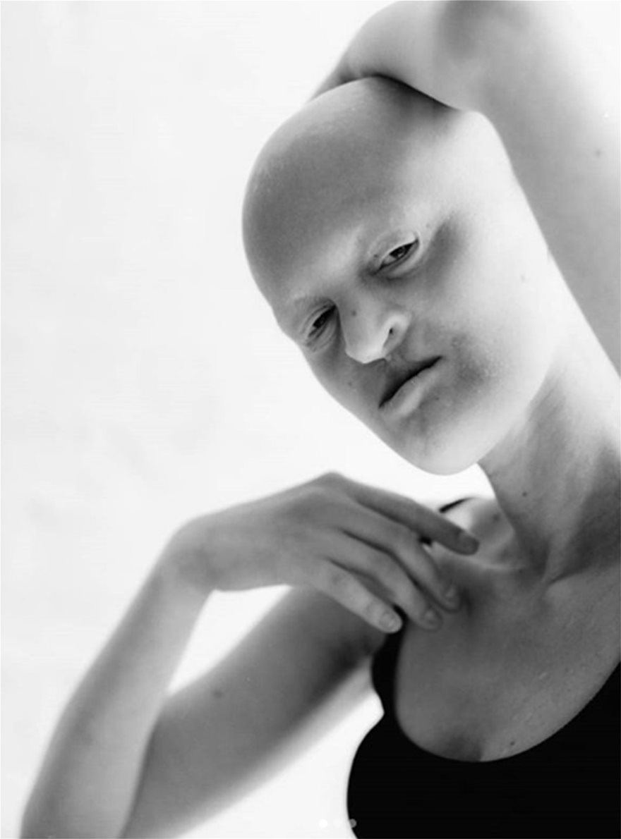 Μέλανι Γκέιντος: Το «τέρας» με τη σπάνια νόσο που έγινε τοπ μόντελ - Φωτογραφία 6