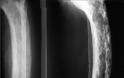 Nόσος Paget των οστών με πόνο, παραμόρφωση οστών, κατάγματα, οστεοαρθρίτιδα, οστεοπόρωση - Φωτογραφία 6