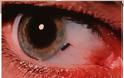 Ξένο σώμα στο μάτι. Τι πρέπει να κάνετε αν μπει κάτι στο μάτι σας; Πρώτες βοήθειες