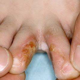 Μύκητες νυχιών και δέρματος με κοκκίνισμα, φαγούρα, πόνο, δυσοσμία. Φυσικές θεραπείες - Φωτογραφία 2