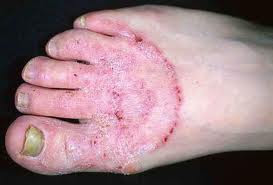 Μύκητες νυχιών και δέρματος με κοκκίνισμα, φαγούρα, πόνο, δυσοσμία. Φυσικές θεραπείες - Φωτογραφία 4