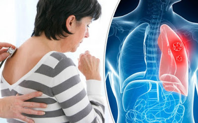 Προσοχή. Ο καρκίνος του πνεύμονα συχνά ΔΕΝ παρουσιάζει συμπτώματα. Αποτελεί την τρίτη συχνότερη μορφή καρκίνου - Φωτογραφία 1