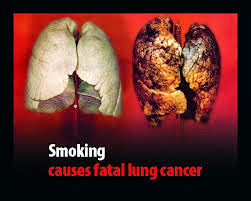 Προσοχή. Ο καρκίνος του πνεύμονα συχνά ΔΕΝ παρουσιάζει συμπτώματα. Αποτελεί την τρίτη συχνότερη μορφή καρκίνου - Φωτογραφία 5