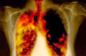Προσοχή. Ο καρκίνος του πνεύμονα συχνά ΔΕΝ παρουσιάζει συμπτώματα. Αποτελεί την τρίτη συχνότερη μορφή καρκίνου - Φωτογραφία 6