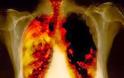 Προσοχή. Ο καρκίνος του πνεύμονα συχνά ΔΕΝ παρουσιάζει συμπτώματα. Αποτελεί την τρίτη συχνότερη μορφή καρκίνου - Φωτογραφία 6